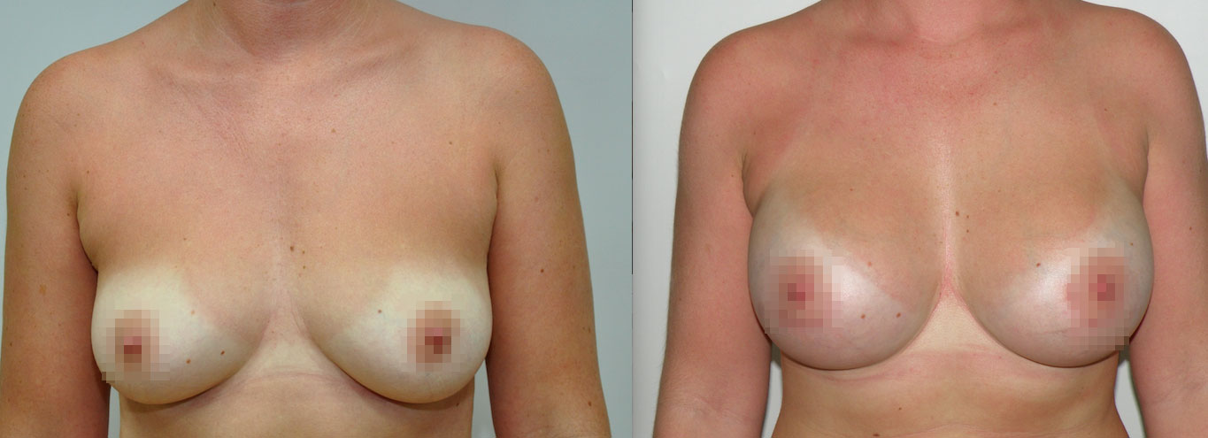 breast augmentation results