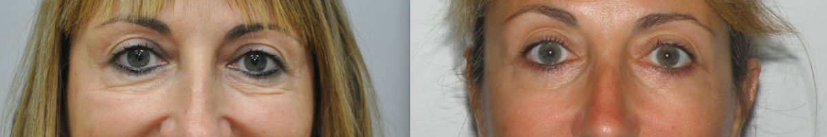 eyelid surgery before after